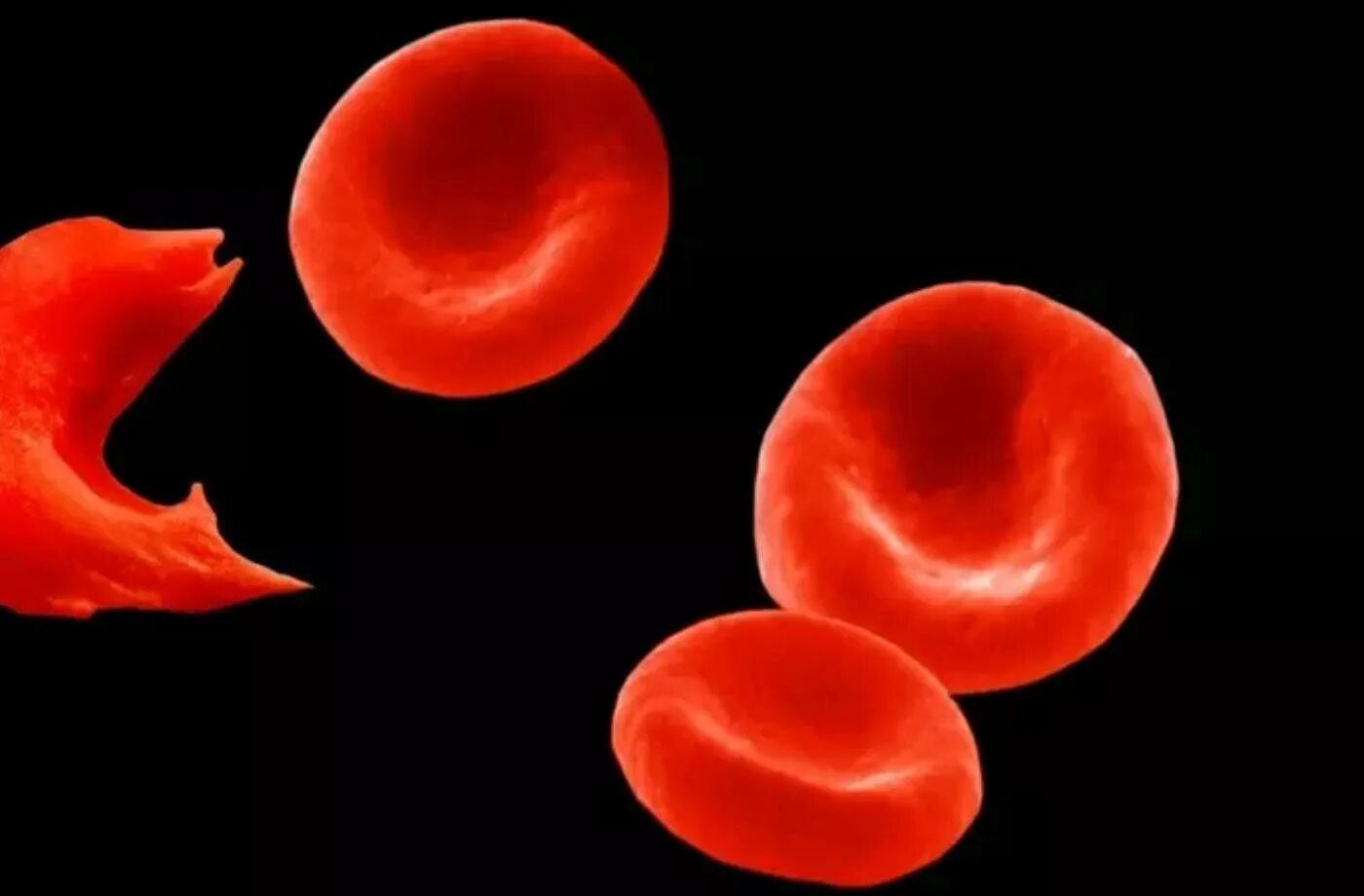 Серповидноклеточная анемия характеризуется. Строение гемоглобина при серповидноклеточной анемии. Ген серповидноклеточной анемии. Серповидноклеточная анемия генная мутация. Эритроциты серповидной формы.