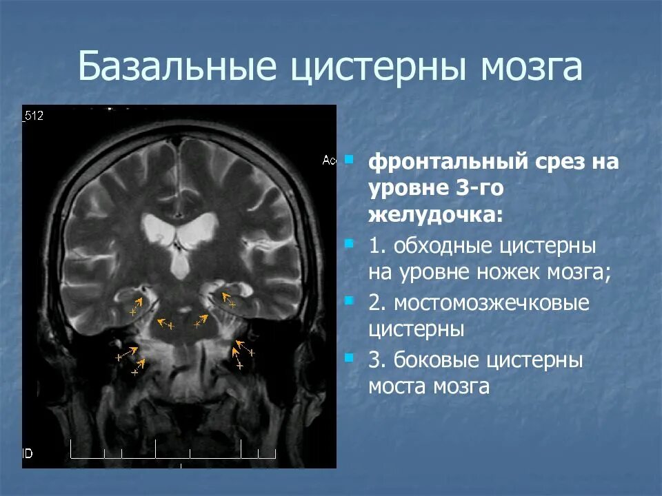 Цистерны мозга расширены. Цистерна Меккеля головной мозг. Базальные цистерны головного мозга кт. Базальные цистерны головного мозга кт анатомия. Базальные цистерны мрт.