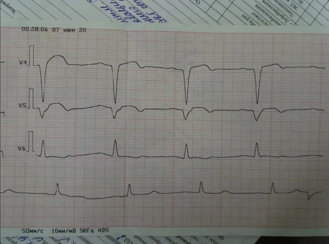 St ишемия. ЭКГ ИБС постинфарктный кардиосклероз. Ишемия миокарда на ЭКГ. Постинфарктный кардиосклероз на ЭКГ. Вазоспастическая стенокардия ЭКГ.