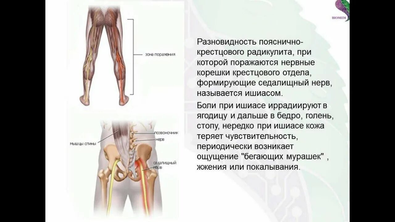 Симптомы поясничной радикулопатии. Пояснично-крестцовый радикулит. Пояснично-крестцовой радикулопатии. Клинический симптом пояснично-крестцовой радикулопатии. Радикулит поясничный симптомы.