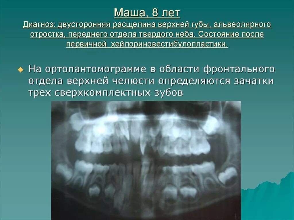 В 19 лет диагноз. Двусторонняя расщелина альвеолярного отростка. Расщелина губы и альвеолярного отростка. Врожденная расщелина альвеолярного отростка. Расщелина верхней губы и альвеолярного отростка.