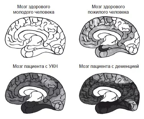 Brain old. Мозг молодого и старого человека. Возрастные изменения мозга. Возрастные изменения головного мозга. Головной мозг пожилого человека.