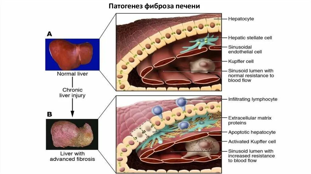 Механизм развития фиброза печени. Патогенез фиброза печени. Фиброз печени этиология.