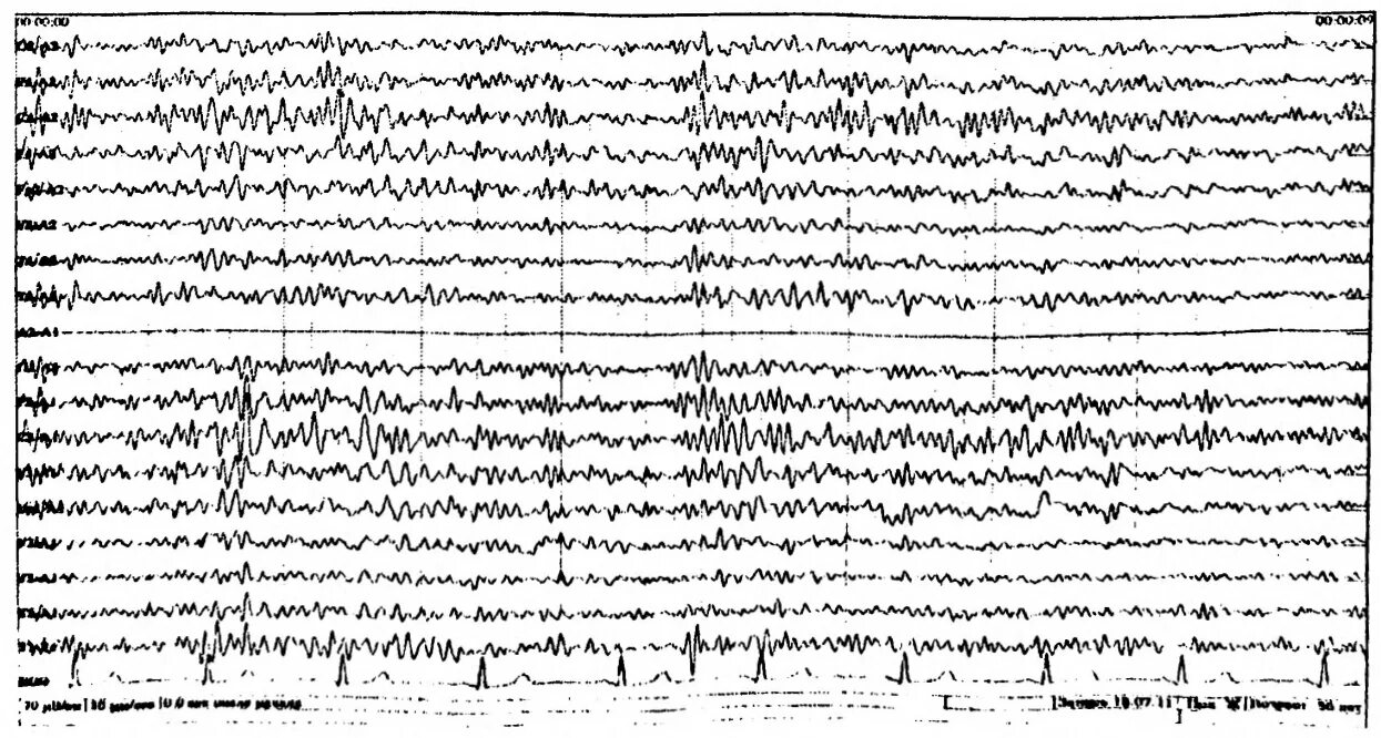 Энцефалограмма. Артефакты энцефалограмма. ЭЭГ ЭМГ. Энцефалограмма электромиограмма. Ээг тверь