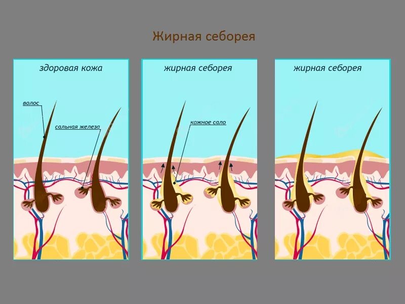 Себорея носогубные складки. Сальные железы кожи головы.