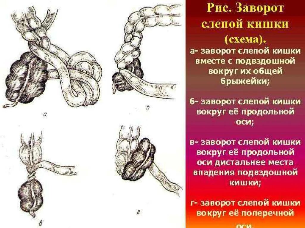 Заворот сигмовидной кишки причины. Симптом тевенара кишечная непроходимость. Заворот кишки признаки симптомы. Операции при завороте сигмовидной кишки. Заворот кишки признаки симптомы.