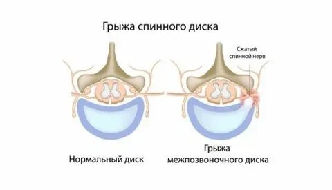 Лечение секвестрированной грыжи без операции