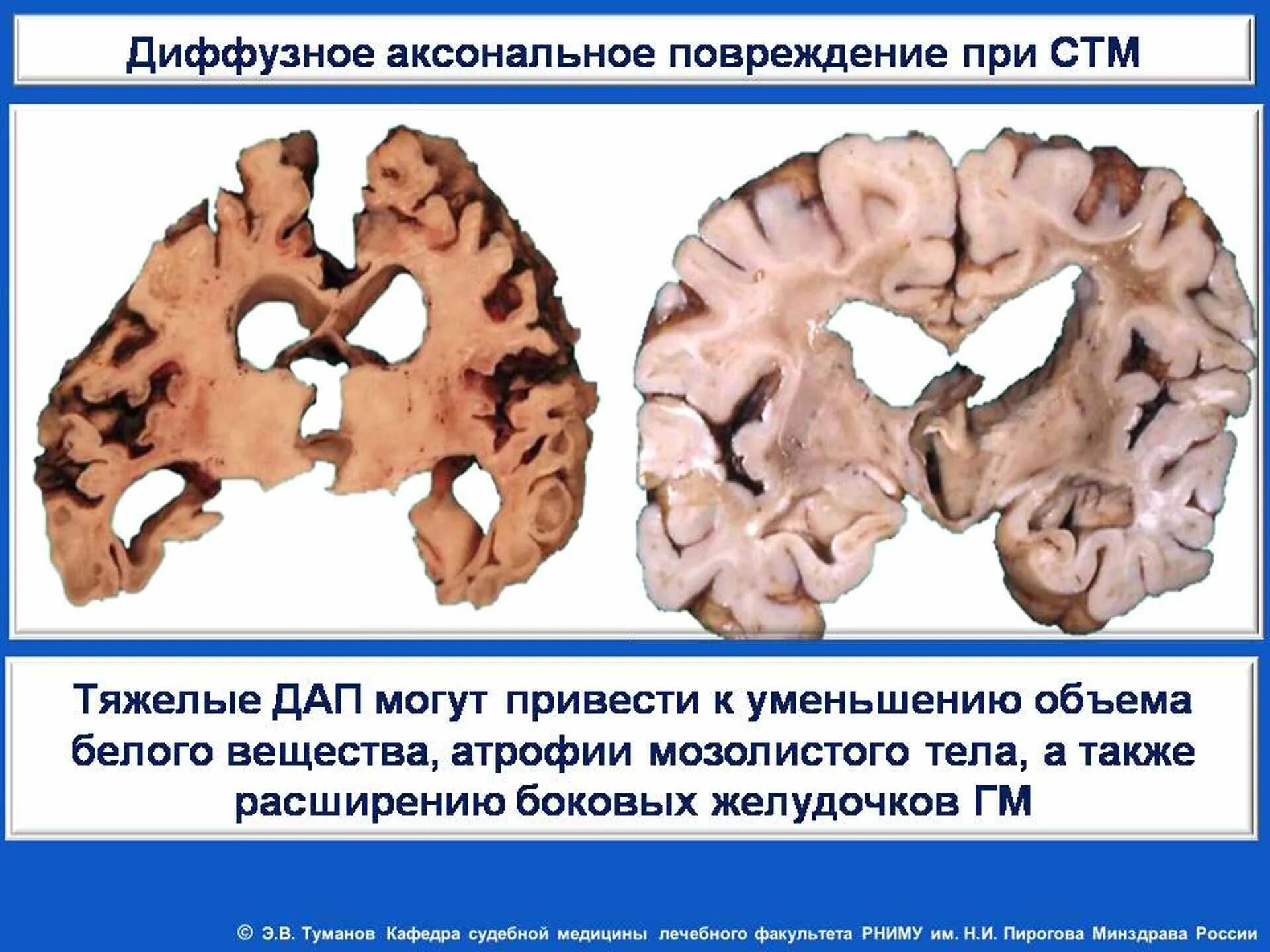 Диффузное поражение головного. Аксональные повреждения головного мозга. Клиника диффузного аксонального повреждения. Диффузное повреждение головного мозга. Диффузно аксальное повреждение.