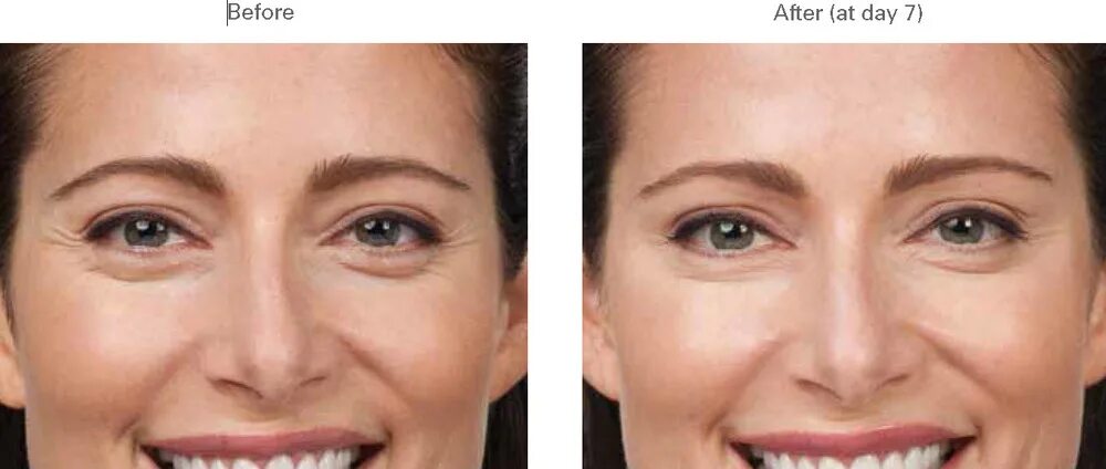 Crows feet. Milk teeth группа. Becky blomfield (milk teeth). Crows feet. Складки под глазами при улыбке.