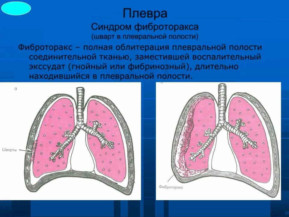 Облитерация полости плевры. Фиброторакс шварты. Легочные плевральные спайки. Шварты в легких это