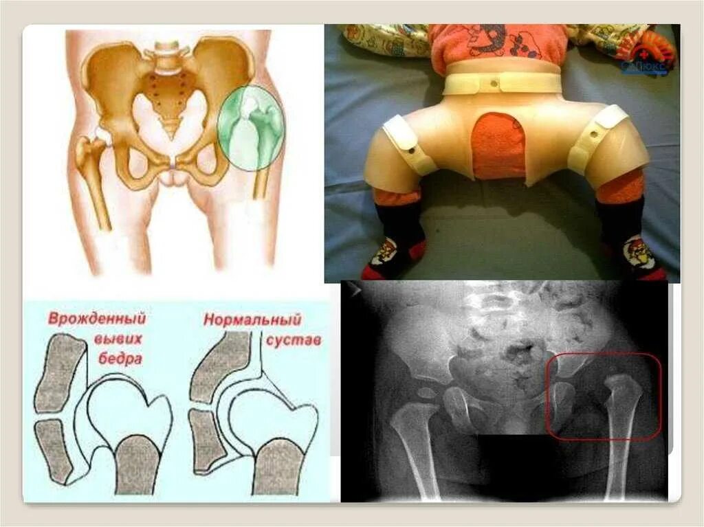 Дисплазия сустава у новорожденного лечение. Дисплазия тазобедренных суставов предвывих подвывих вывих. Врожденный вывих тазобедренного сустава. Дисплазия тазобедренных суставов crowe1. Врожденный вывих бедра (дисплазия бедра).