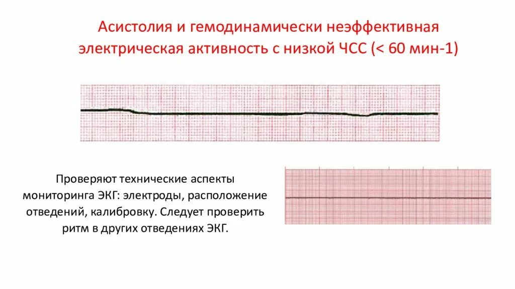 Асистолия на ЭКГ. Асистолия сердца на ЭКГ. Асистолия на кардиограмме. Асистолия на ЭКГ описание.