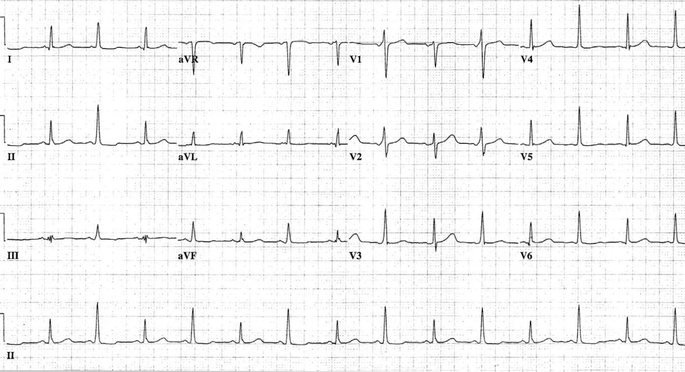 Амплитуда qrs. Ав блокада 2 степени с выпадением qrs. qrs типа rsr. аберрация на экг qrs. qrs типа qs.