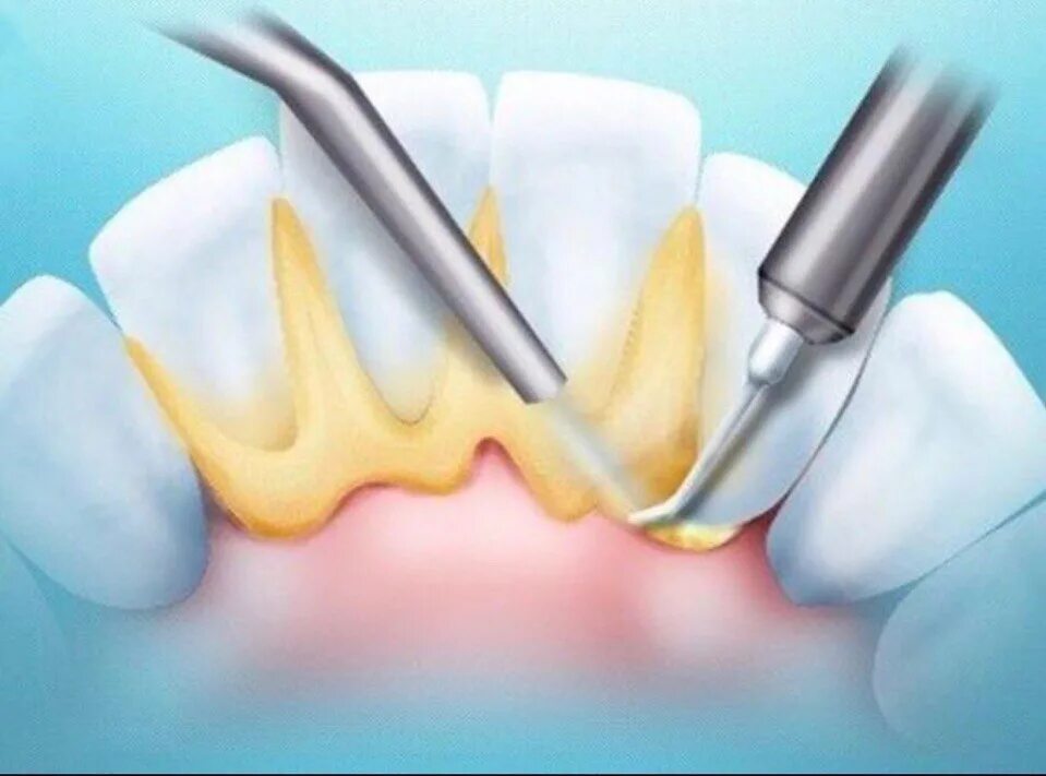 Поддесневой зубной камень. Профгигиена (ультразвук + Air-Flow). Поддесневой белый зубной камень. Зубной камень наддесневые отложения. Как чистить десна