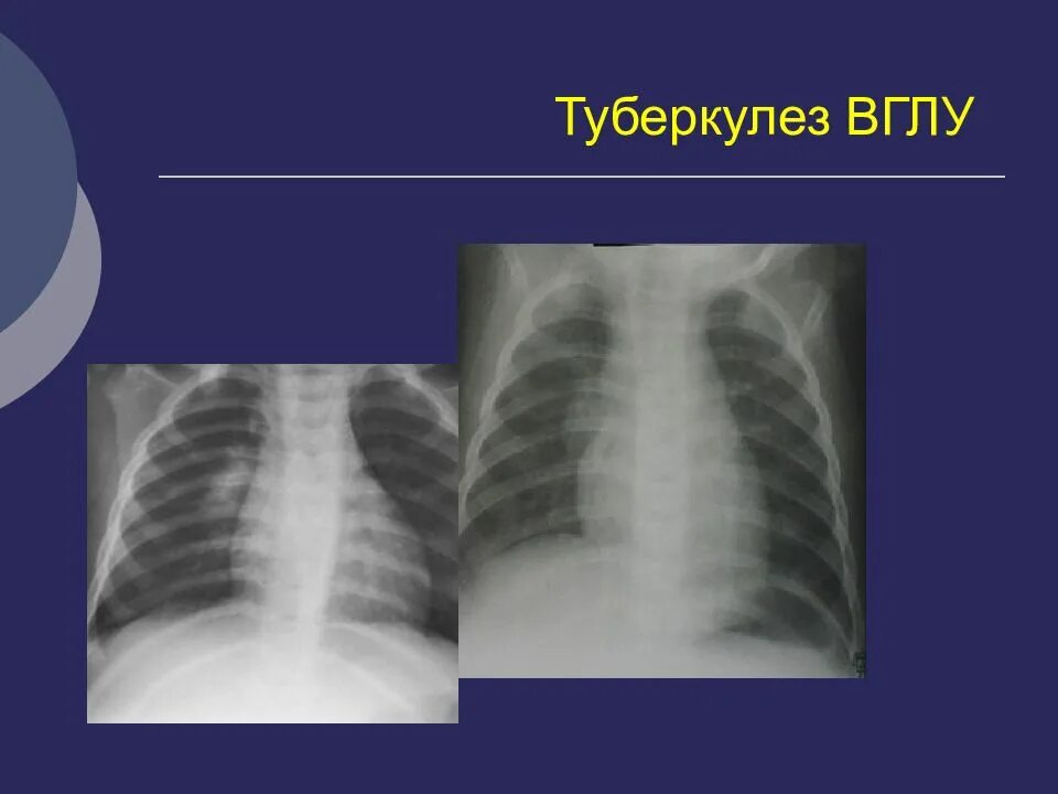 Увеличение внутригрудных лимфатических узлов. Туберкулез внутригрудных лимфатических узлов рентген. туберкулез внутригрудных лимфатических узлов снимки. туберкулез внутригрудных лимфатических узлов рериген. туберкулёз лимфоузлов рентген.