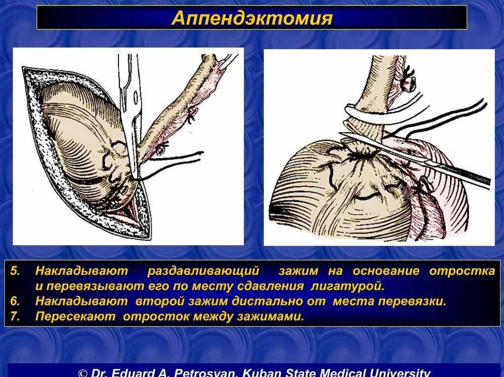 Аппендэктомия этапы операции. Антеградная аппендэктомия этапы. Классическая аппендэктомия. Этапы операции при аппендэктомии. Назовите этапы операции