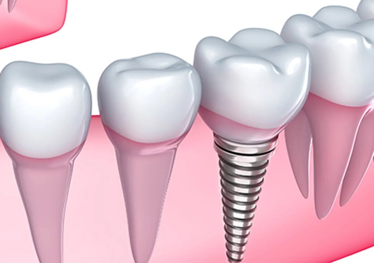 Сколько стоят зубы человека. Мостовидный протез или имплантация зубов.