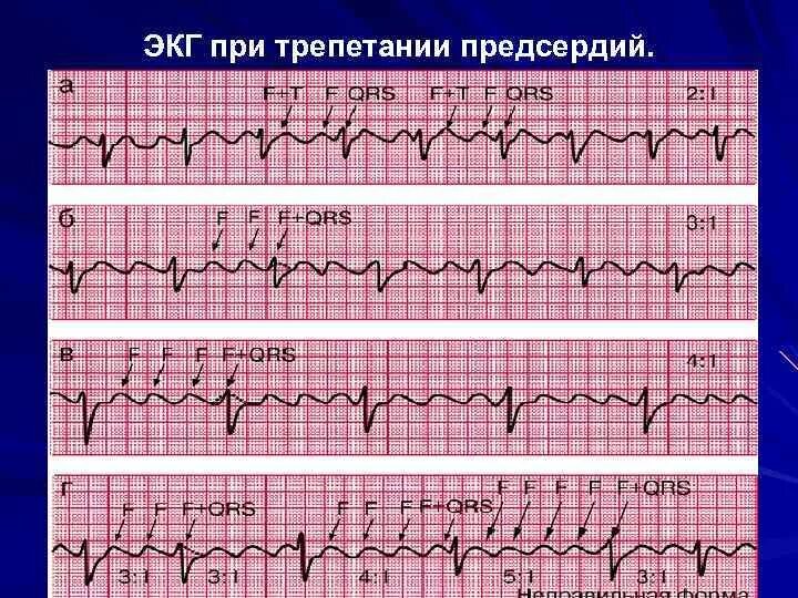 Трепетание предсердий 2 1. Трепетание предсердий 2 к 1 на экг. трепетание предсердий 1 к 1 на экг. экг типичное трепетание предсердий 2:1. фибрилляция и трепетание предсердий на экг.