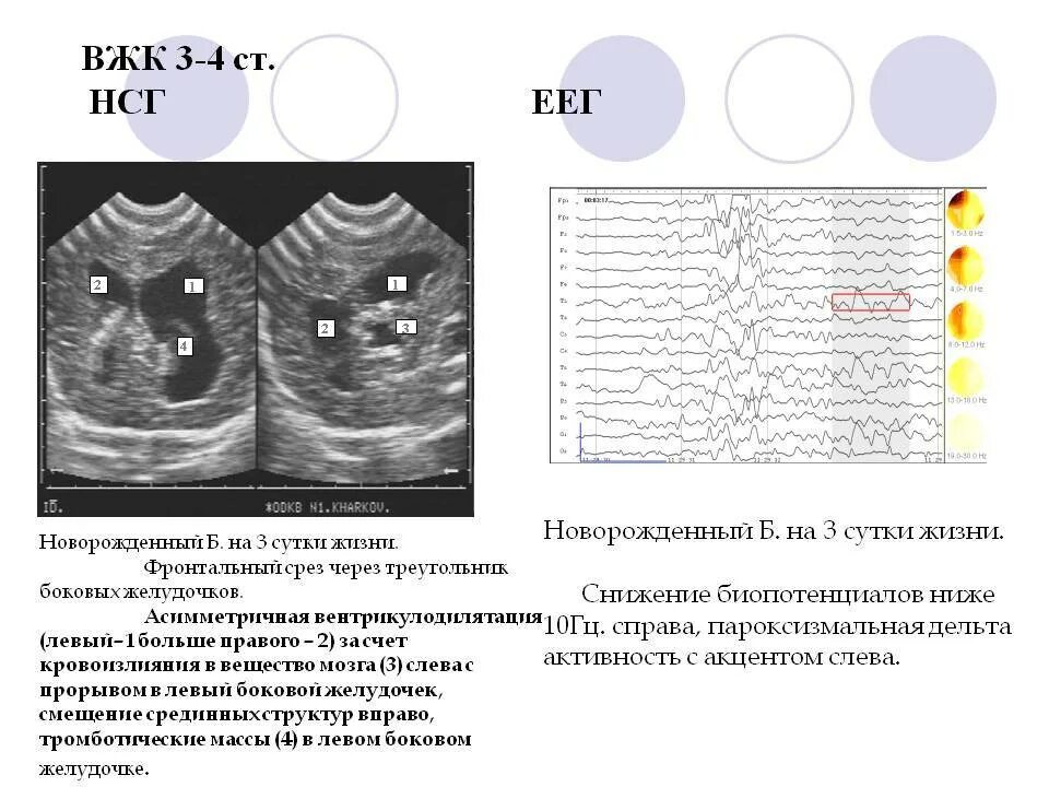 Кровоизлияние в мозг у новорожденного степени. Вжк 1 степени у новорожденных узи. вжк 2 степени у новорожденных узи. вжк 3 степени у новорожденных узи. вжк 2-3 степени у новорожденных.