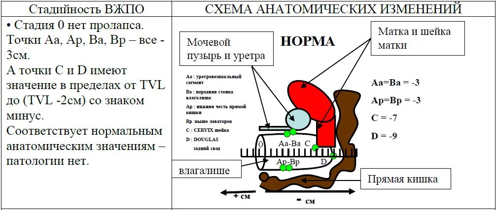 Выпадение женских половых. Классификация Pop-q. Pop q классификация пролапса. Классификация Pop q выпадение матки. Максимальная длина пролапса.