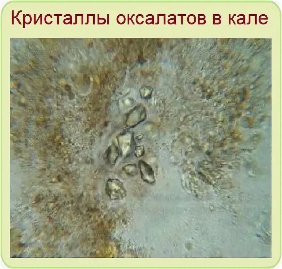 Кристаллы гематоидина в кале у ребенка. Кристаллы трипельфосфаты в кале у взрослого. Кристаллы шарко-лейдена в кале. Микроскопия кала растительная клетчатка непереваримая. Микроскопия кала растительная клетчатка непереваримая.