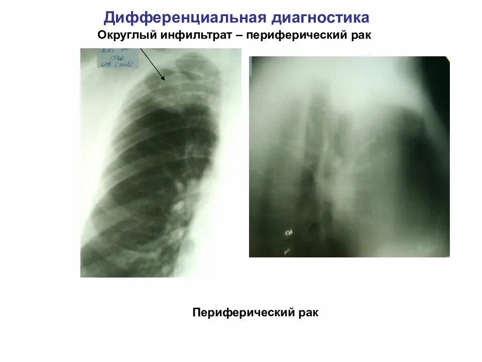 Округлый инфильтрат. Округлый инфильтративный туберкулез рентген. Округлый инфильтрат туберкулез. Инфильтративный туберкулёз округлый инфильтрат диагноз. Туберкулезный инфильтрат дифференциальная.