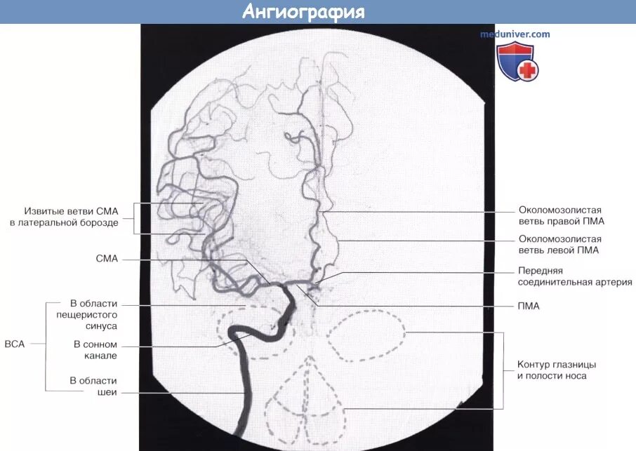 Сегмент а1 пма. Ангиография средней мозговой артерии. Внутренняя Сонная артерия ангиография. Сегменты средней мозговой артерии мрт. Средняя мозговая артерия мрт.