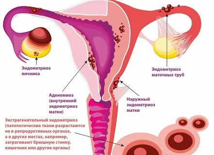 Endometriosis