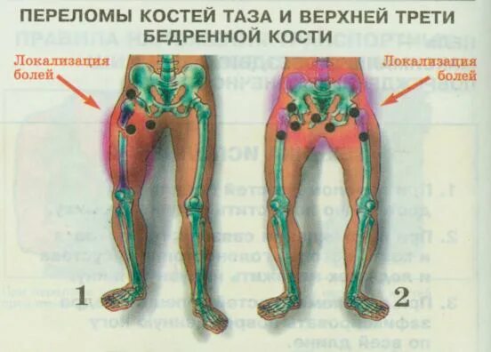 перелом нижней трети части бедра. открытый перелом бедра. первая треть бедра. первая треть бедра. перелом бедренной кости нижней трети операция.