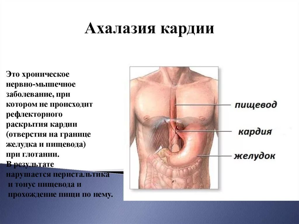 Пищевод не смыкается. Ахалазия кардиальной части пищевода.