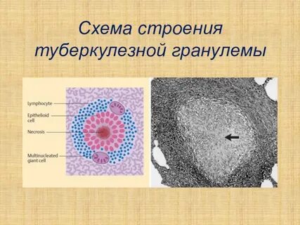 Гранулема туберкулеза