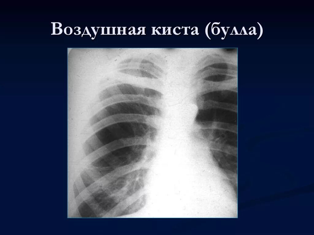 Врожденные кисты легких. Однолегочная эмфизема (синдром маклеода) кт. Врожденные кисты легких. Ретенционная киста легкого. Врожденные кисты легких.