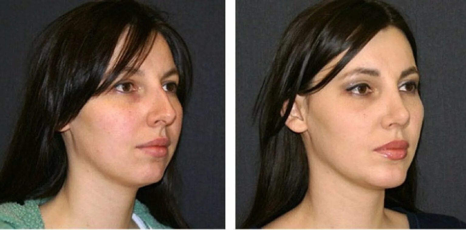 Бабич до и после ринопластики. Аугментационная ринопластика носа. Ринопластика до и после. Пластика кончика носа.
