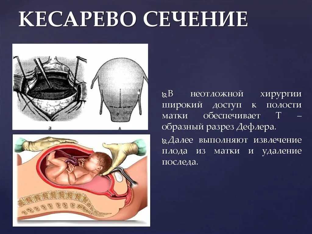 Кесеровое сечение