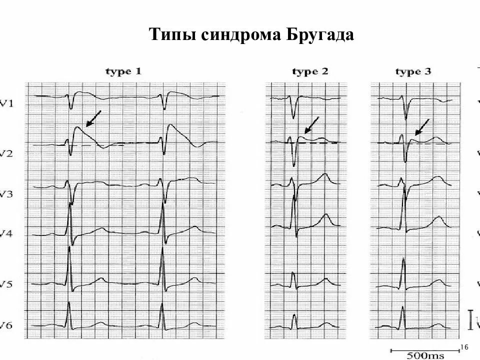 Синдром бругада тип 2 экг. Синдром преждевременной реполяризации желудочков. Экг при синдроме бругада. Экг-критерии синдрома бругада 3 типа. Бругада экг признаки.