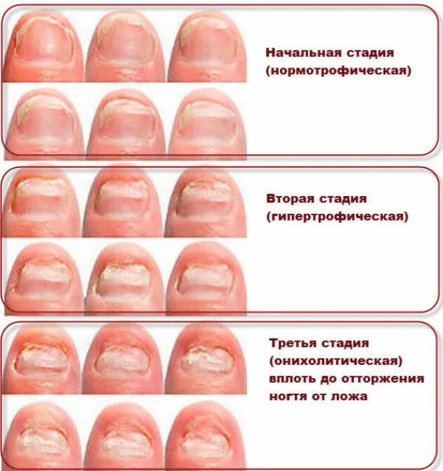 Почему ногти становятся тонкими. Дистально латеральная форма онихомикоза. Онихомикоз — грибковое поражение ногтей.. Грибковые заболевания ногтей классификация. Симптомы поражения грибком ногтевой пластины.