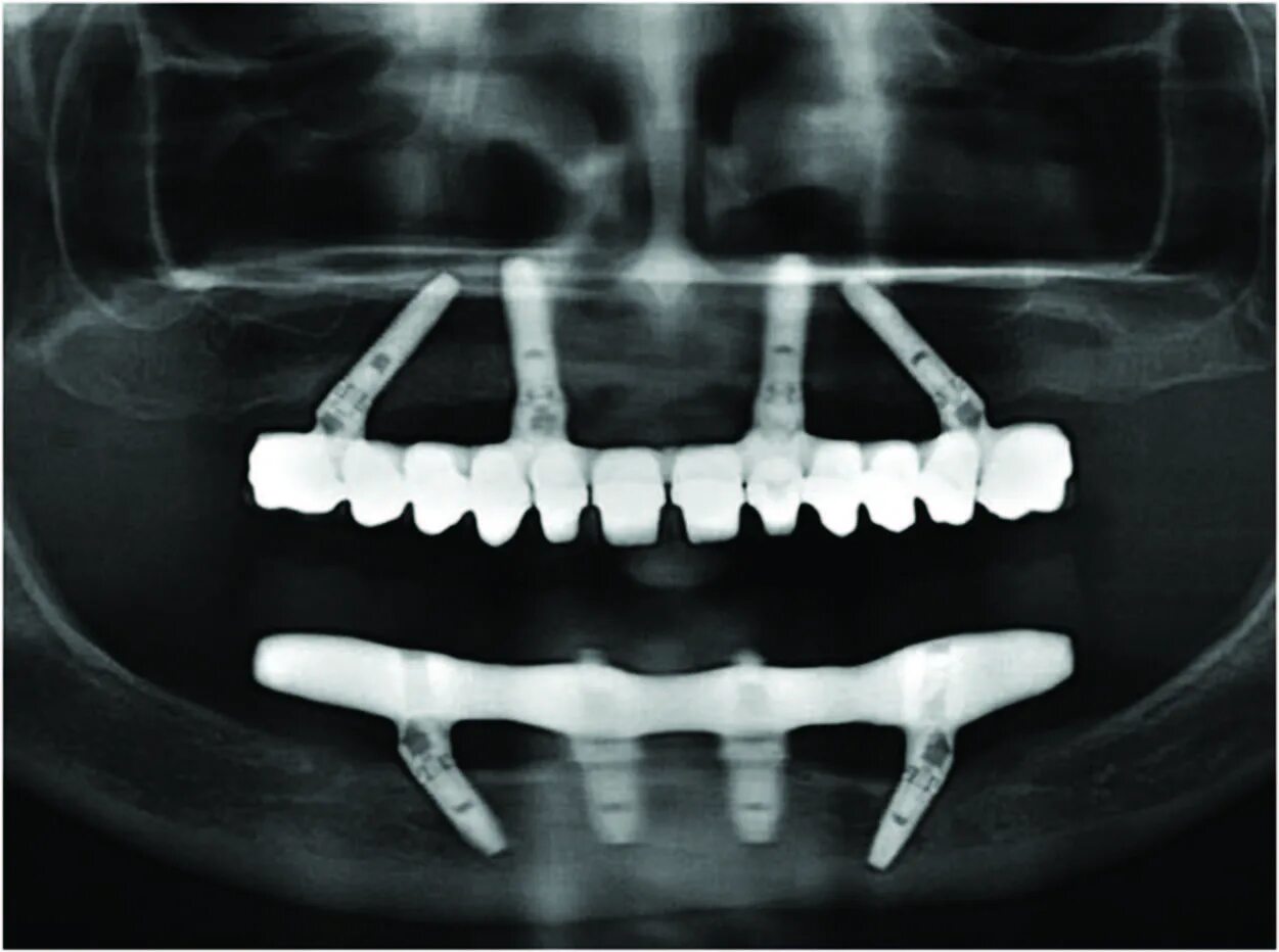 Имплантация all on 4 челюсть.