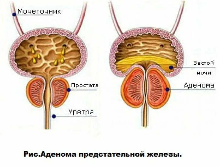 Влияние простатита. Аденома предстательной железы схема. Доброкачественная гиперплазия (аденома) предстательной железы. Строение аденомы простаты. Схема лечения аденомы предстательной железы у мужчин.