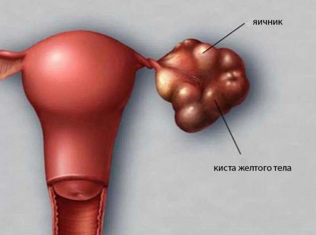 Болят ли придатки. Киста желтого тела яичника. Лютеиновые кисты яичника. Фолликулярная киста яичника.