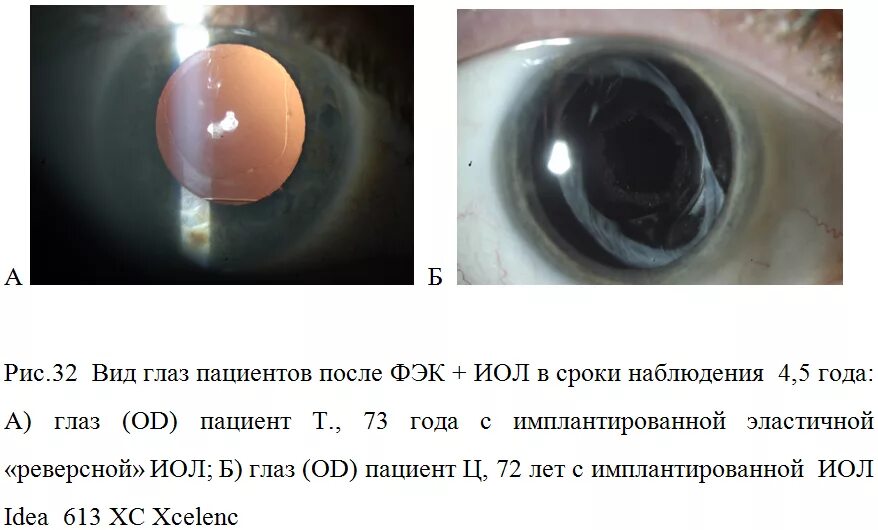 Новгород операция катаракта. Факоэмульсификация катаракты с имплантацией ИОЛ. Протокол операции факоэмульсификации катаракты.