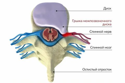 Епифанов грыжа