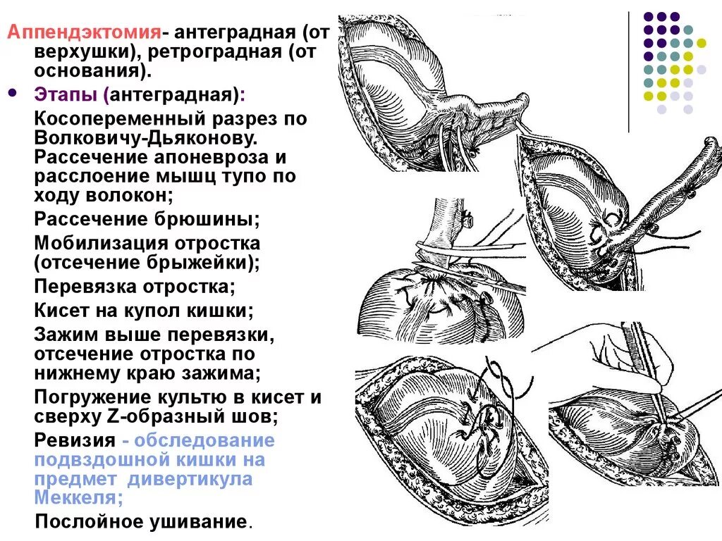 Этапы типичной аппендэктомии. Ретроградная аппендэктомия этапы. Аппендэктомия этапы операции. Аппендэктомия по Волковичу Дьяконову ход операции.