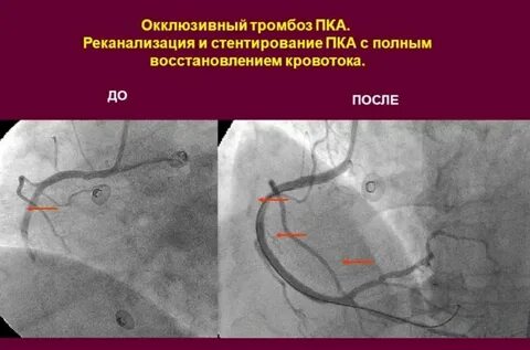 Канализация тромба