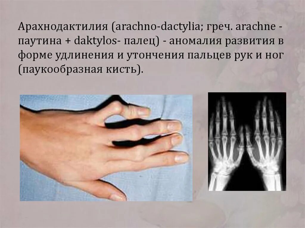 Синдром длинных пальцев. Синдром марфана (арахнодактилия). арахнодактилия паучьи пальц. синдром марфана заболевания соединительной ткани. кисти рентген синдром марфана.