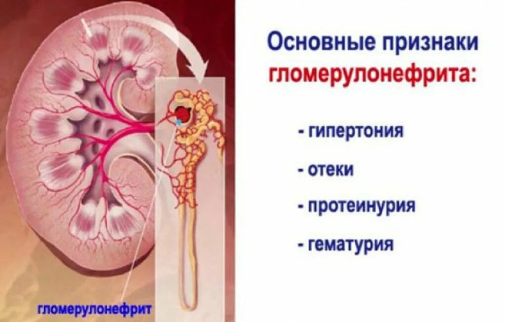 Заболевание почек гломерулонефрит. Острый нефрит и гломерулонефрит. Гломерулонефрит почек симптомы. Почечные симптомы гломерулонефрита. Острый гломерулонефрит у детей симптомы.