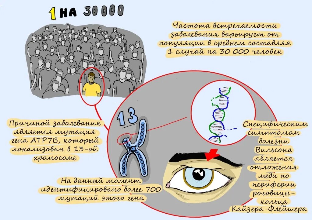 Кольцо Вильсона Коновалова. Болезнь Вильсона Коновалова болезнь Вильсона-Коновалова.