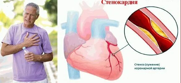 Стенокардия фото. Стенокардия грудная жаба. Стенокардия или грудная жаба. Стенокардия напряжения картинки.