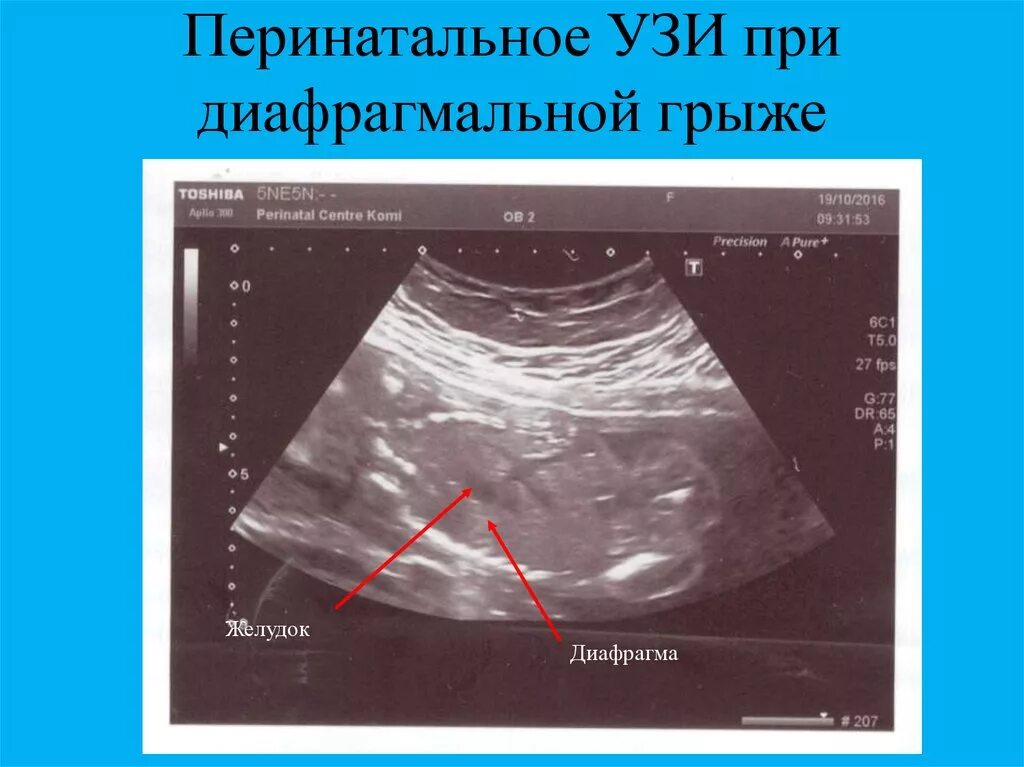 Диафрагмальная грыжа на УЗИ. УЗИ признаки диафрагмальной грыжи.