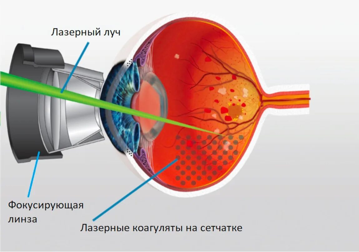 Лазеркоагуляция сетчатки. Барьерная лазерная коагуляция сетчатки. Панретинальная лазерная коагуляция. Лазерная коагуляция после операции