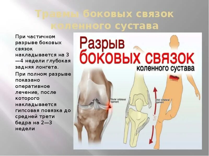 Повреждение коленной связки симптомы. Боковая связка коленного сустава. Повреждение внутренней боковой связки коленного сустава. Повреждение боковых связок коленного сустава. Разрыв внутренней боковой связки коленного сустава.